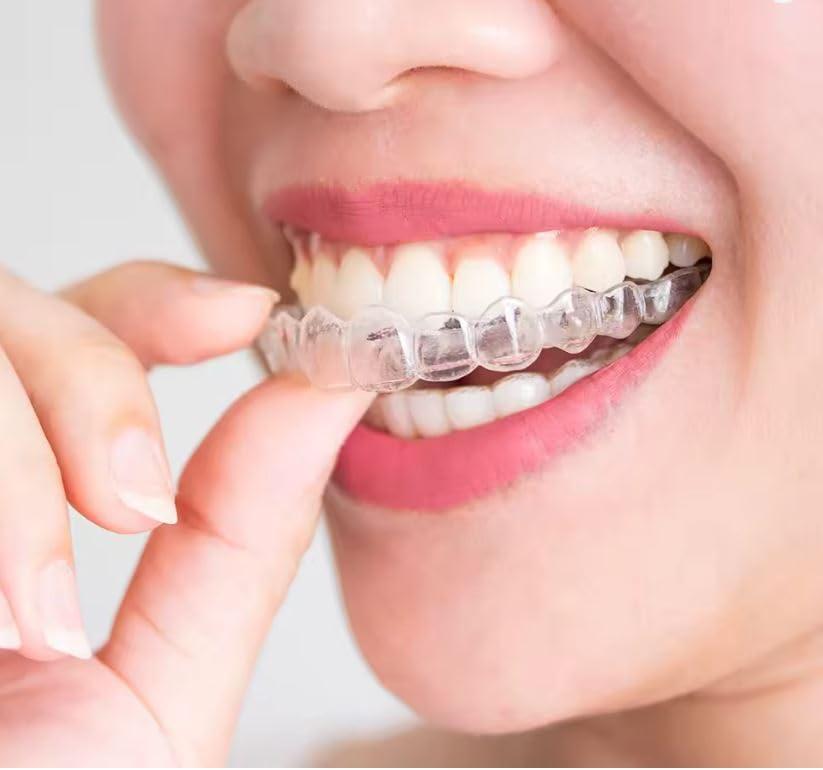 Paradenti sportivo termo-modellabile “boil & bite” – 1 coppia (superiore + inferiore) – adulto